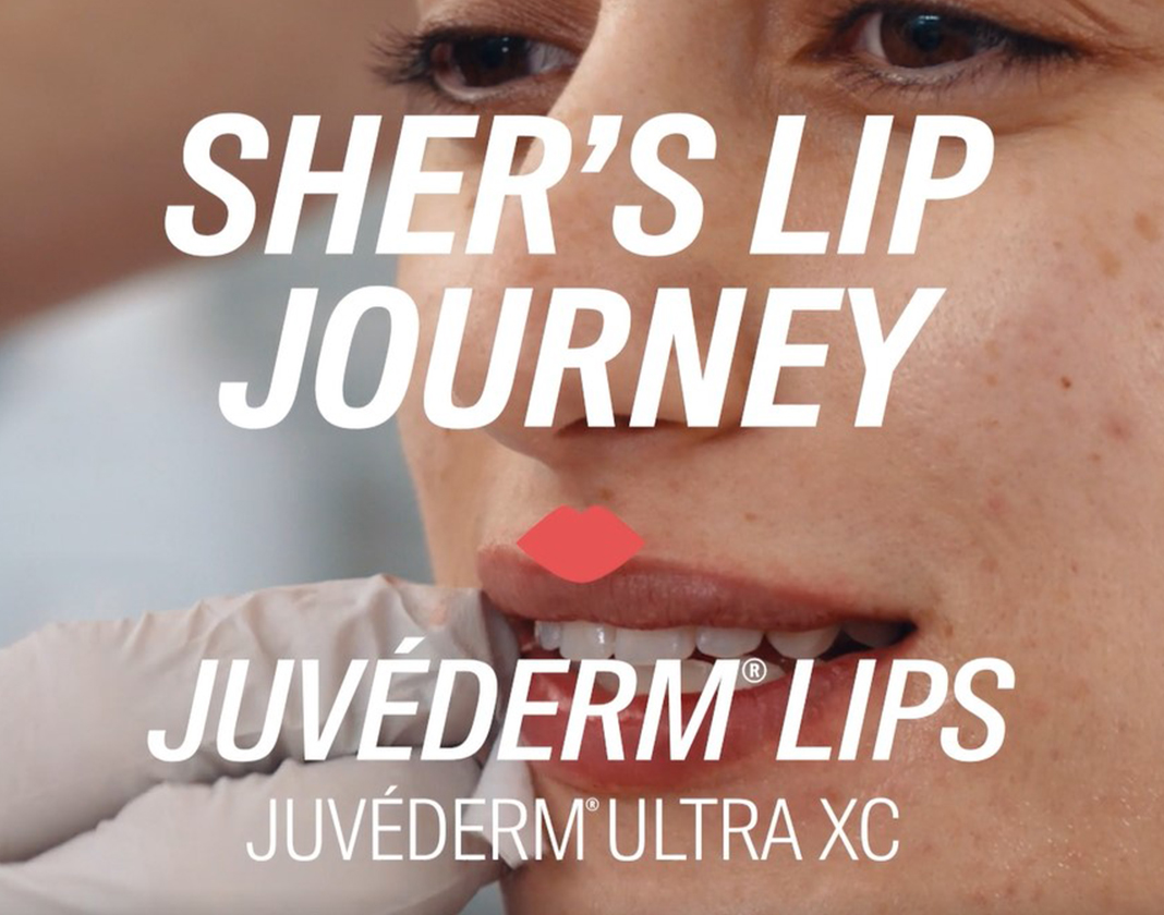 Juvederm Lips Don't Lie