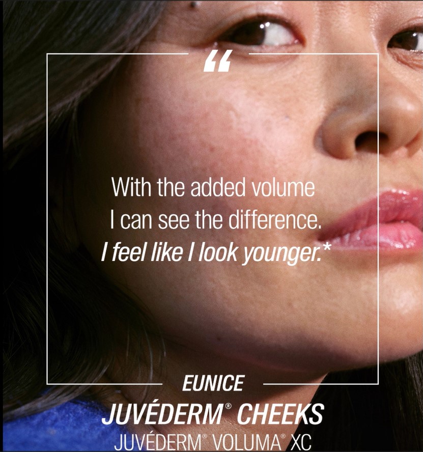 Juvederm Add Volume to Your Cheeks