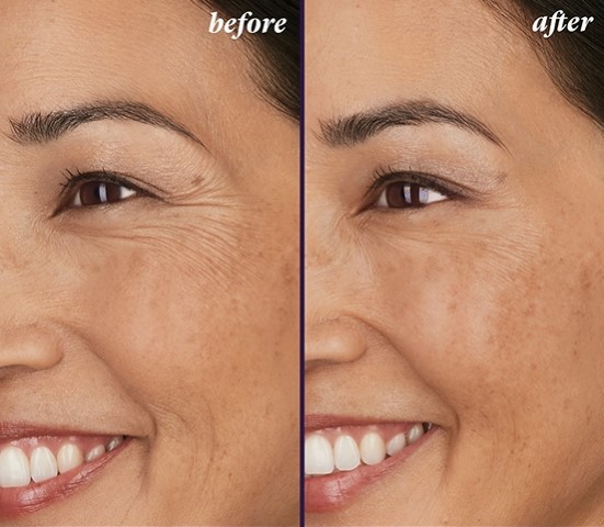 BOTOX® COSMETIC – Diana Before and after