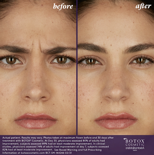 BOTOX Cosmetic Gia Before and After