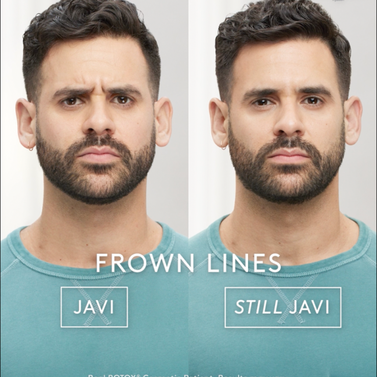 Javi's Transformative Journey: Before-and-After Results with BOTOX® Cosmetic 